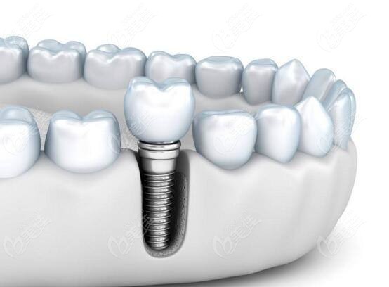  How much is it with Yangquan implant teeth