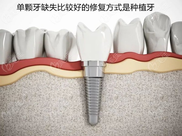 单颗牙齿缺失是做种植牙还是烤全瓷牙