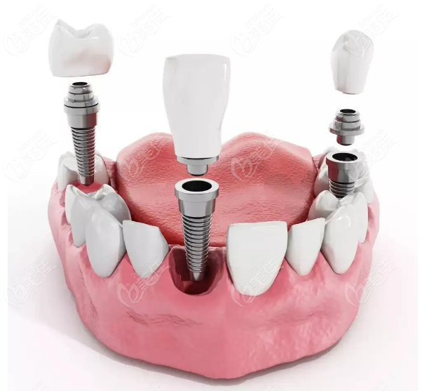  How much is a tooth implant? 2022