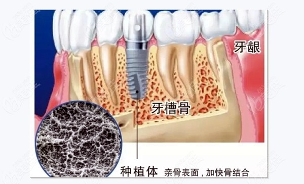 才33岁牙齿就要烂光了