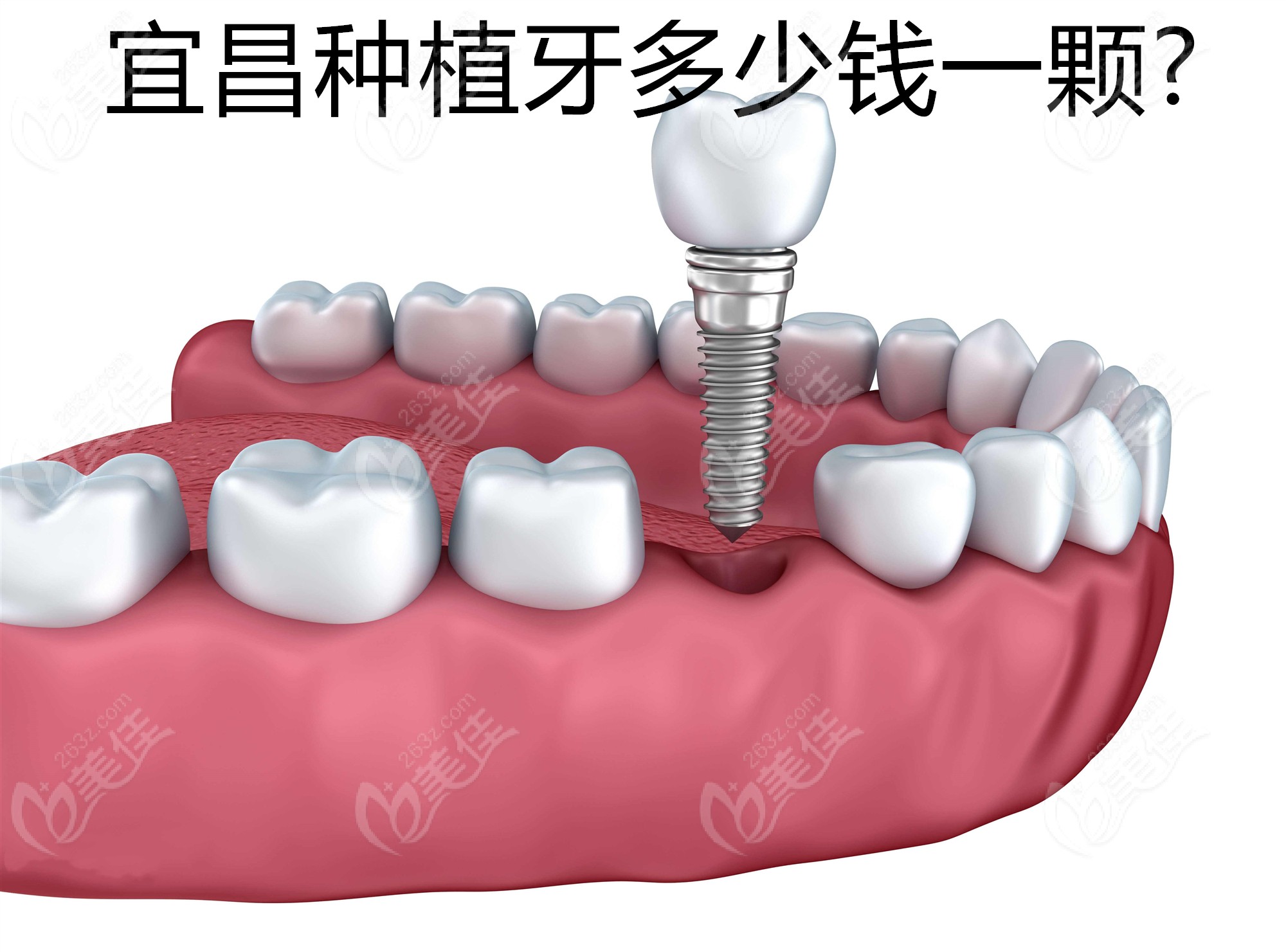 宜昌种植牙一般多少钱一颗