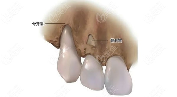 正畸形成骨开窗怎么治疗
