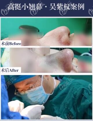  Does Dr. Wu Ziquan of Dalian Sha have a good effect on nasal augmentation