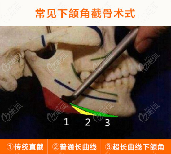 中山一院刘祥厦做磨骨挺出名的