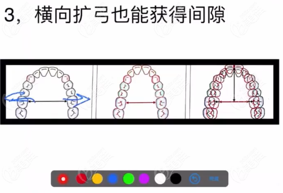 正畸不拔牙也可以内收5-7毫米