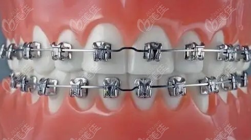  How much does Yiyang orthodontics cost