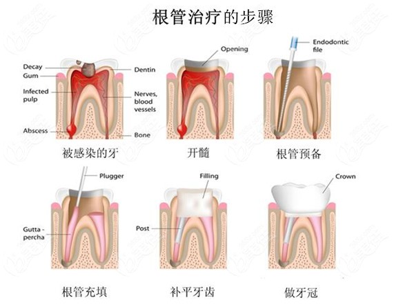  Finally, I got the expense table of root canal therapy in Hangzhou Stomatological Hospital