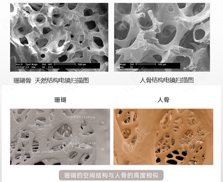  Which is better, coral bone filling forehead or autologous fat