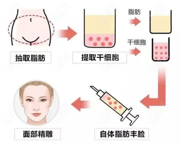  The doctors who do facial fat filling well in Nanchang are Tu Feixiang/Zhou Fangbin/Yang Qi, etc