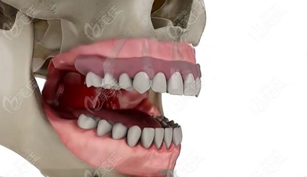  Detailed steps for declassifying allon4 and allon6 implant teeth