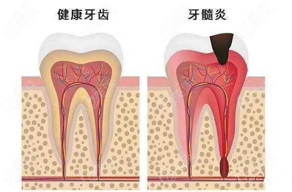 活髓全瓷牙的利与弊了解下