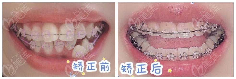  Where in Chengdu is tooth correction cheap and effective