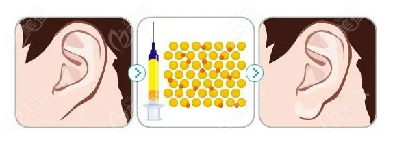  What is the price of autologous fat ear lobe