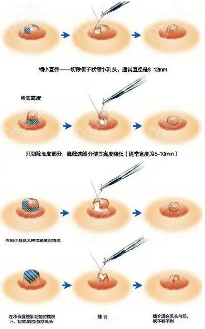  It's true that Chongqing Contemporary Ankeron has had chest reduction surgery