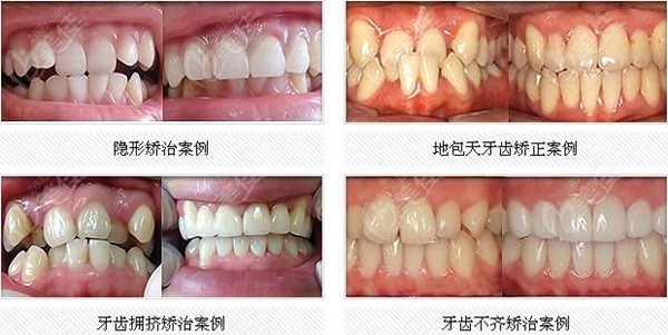  Nanning Dental Orthodontics Price List