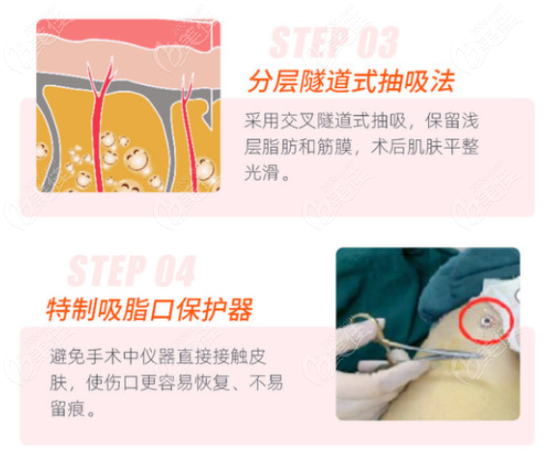  Which doctor in Hefei Huamei is better at liposuction