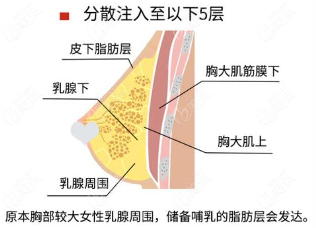  How much does Xuchang have to ask the hospital that has done breast augmentation surgery for autologous fat breast augmentation