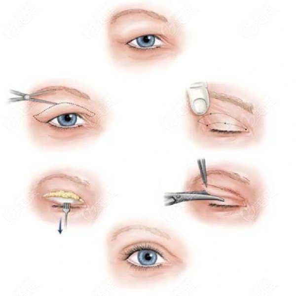  How about Huamei's double eyelid cutting technique in the top five of Jiuquan Plastic Surgery Hospital