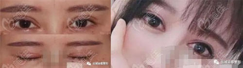  Yuncheng full cut eyelid repair