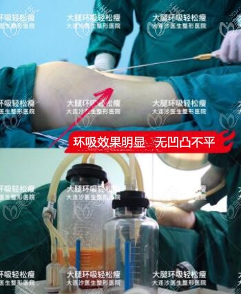  How much is the price of liposuction in Dalian