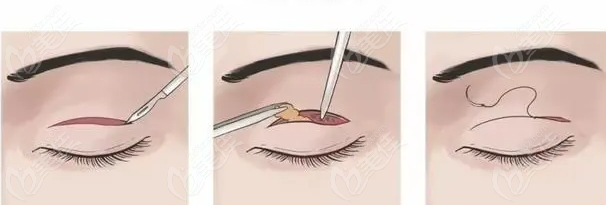  How about Dr. Sun Feng's double eyelid cutting and eye repair