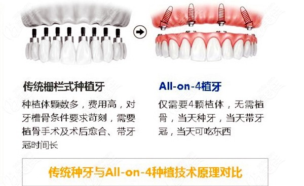 才33岁牙齿就要烂光了