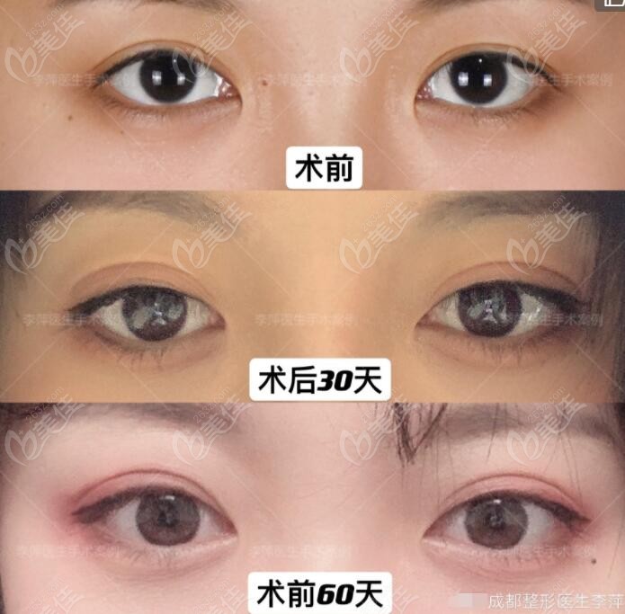  Recommended by Top Ten Doctors of Eye Repair in Chengdu