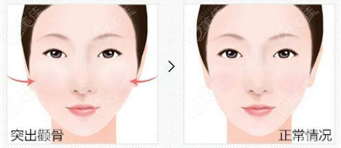  The operation price of Wuhan zygomatic internal pushing and mandibular angle includes the example of Wuhan mandibular angle internal pushing and grinding