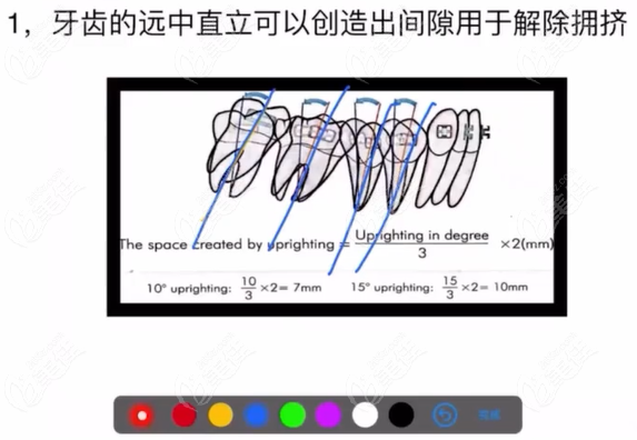 正畸不拔牙也可以内收5-7毫米