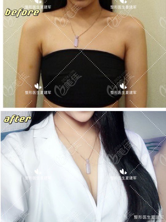  Recommended by popular doctors for breast augmentation in Nanjing