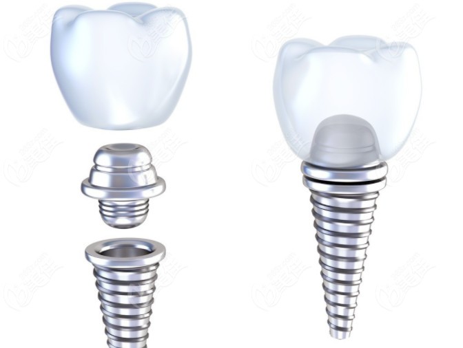  The dental implant in Fengze District, Quanzhou is not only technically good