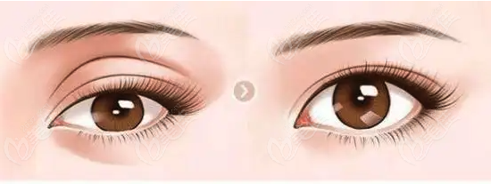  Top 10 domestic double eyelid surgery hospitals