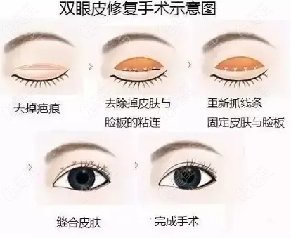  Which doctor in Xi'an did a good job in repairing double eyelid