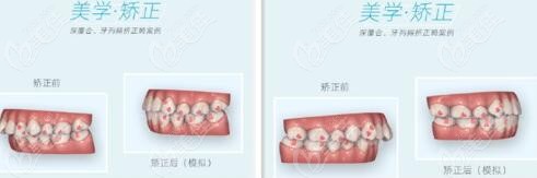 隐形矫正中的咬合跳跃是什么意思