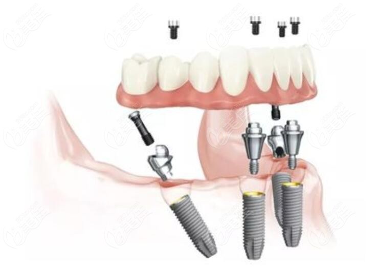  Which dental implant hospital in Ya'an is good