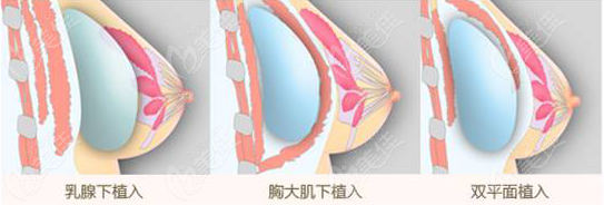  Zhuzhou Yamei breast augmentation is good