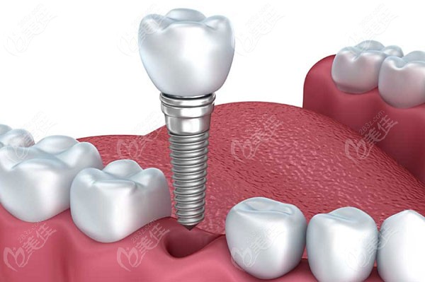  How much is a minimally invasive dental implant in Quzhou City Dental Hospital