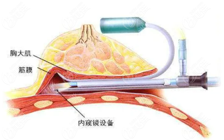 中国做隆胸手术哪个医生好