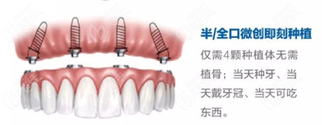  The new technology of full mouth dental implant in Hangzhou depends on President Wang Ming's all-on-4 and zygomatic implant bar