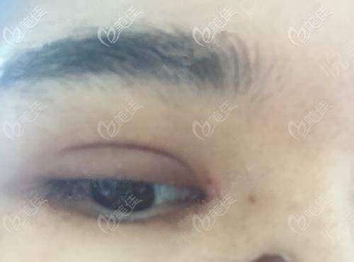  Can the blackened upper eyelid recover after three months of double eyelid surgery