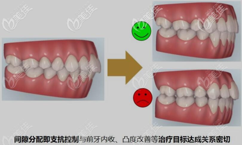 美国隐适美隐形牙套做拔牙矫正效果好吗