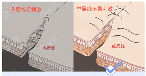  Doctor Wang Zhidong from Shenzhen has a reliable double eyelid technique