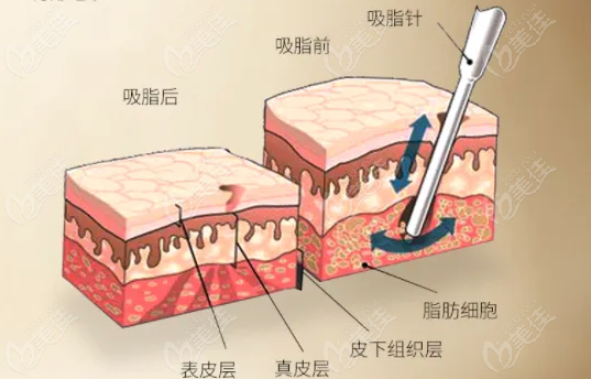  Ranking of liposuction doctors in Guiyang