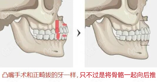  Which hospital doctor did a good job in the operation of bone protruding mouth in Chongqing