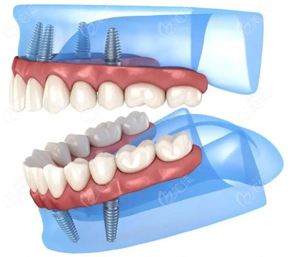  How much is it with Yangquan implant teeth