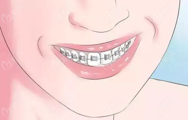  Ask the dental hospitals in Zhongshan how much the cost of braces is