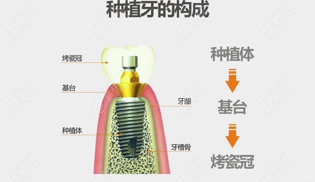 种植牙位置不够怎么办