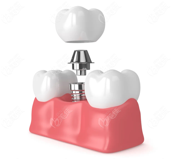  How much is a tooth implant? 2022