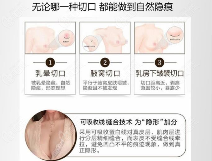  How much is the price of breast augmentation with mando prosthesis in Wuhu, a better hospital for breast augmentation surgery