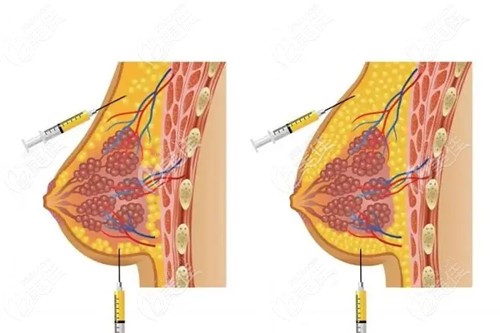  Ranking of fat breast enhancement doctors in Harbin